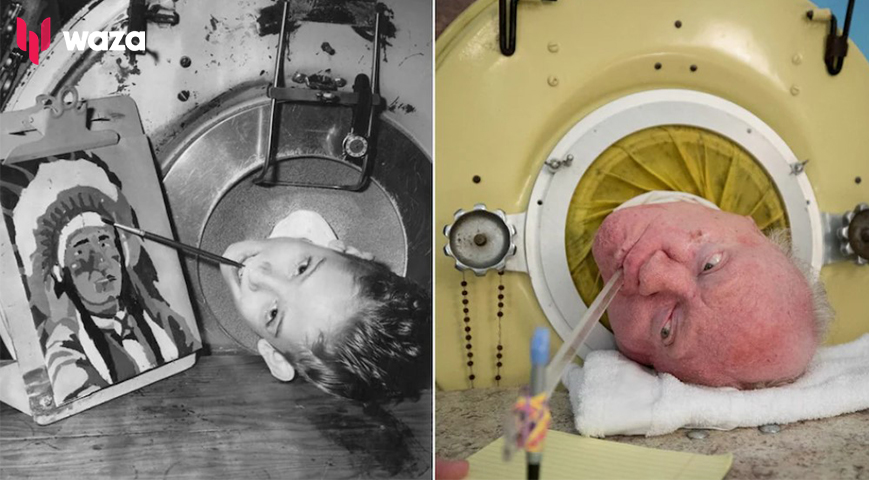 Man Who Spent Most Of The Past 70 Years In An Iron Lung Dies